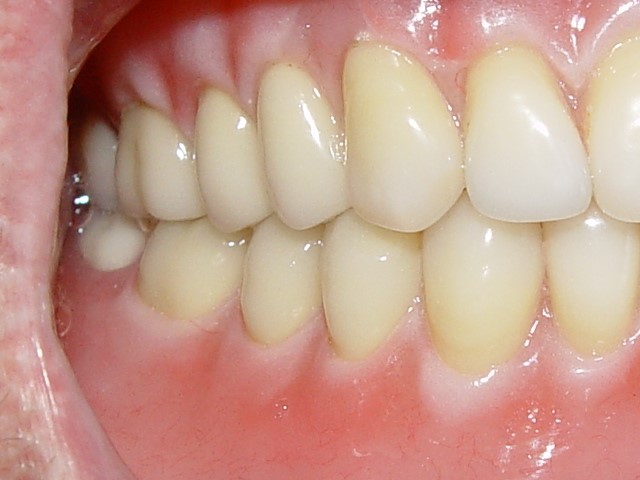 Lower Dentures Aubrey TX 76227